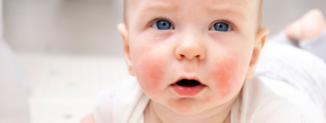 Causas de la dermatitis atópica del bebé: Guía completa para comprender y tratar esta afección