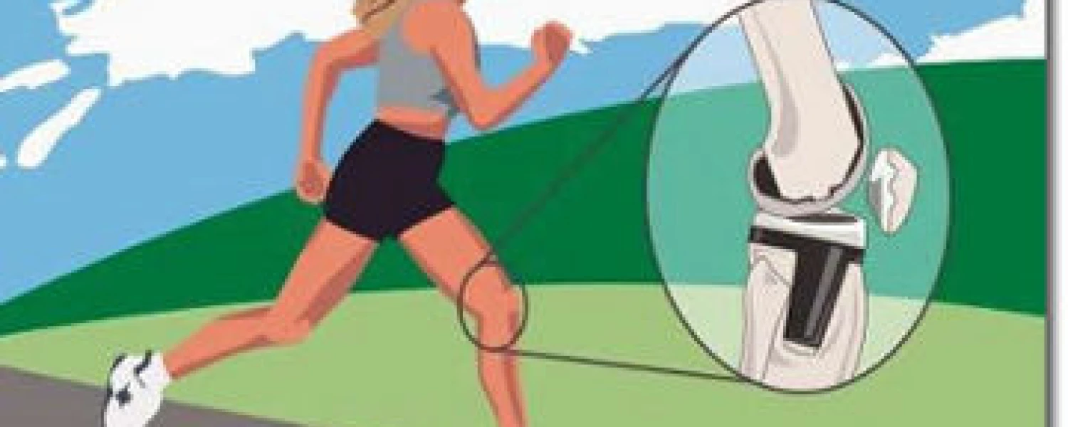El ácido hialurónico, una importante opción en artrosis de rodilla.