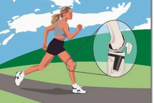 El ácido hialurónico, una importante opción en artrosis de rodilla.
