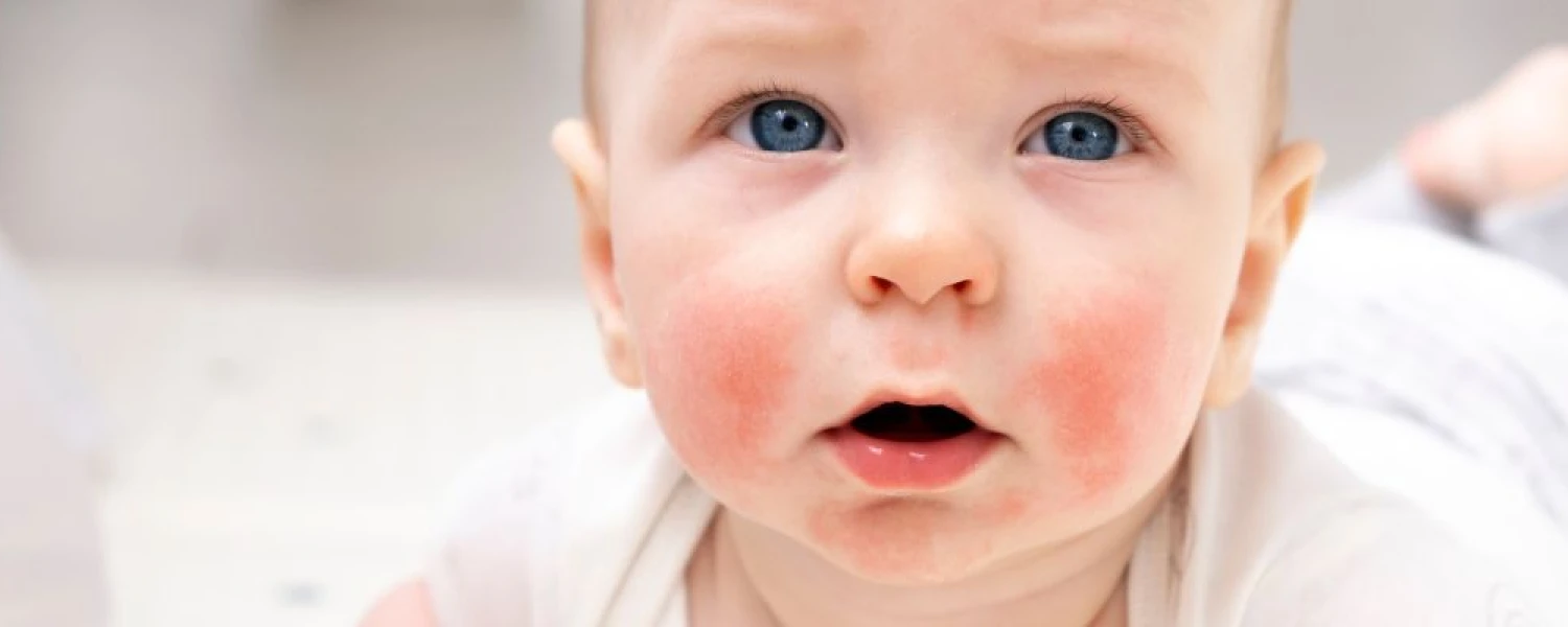 Causas de la dermatitis atópica del bebé: Guía completa para comprender y tratar esta afección