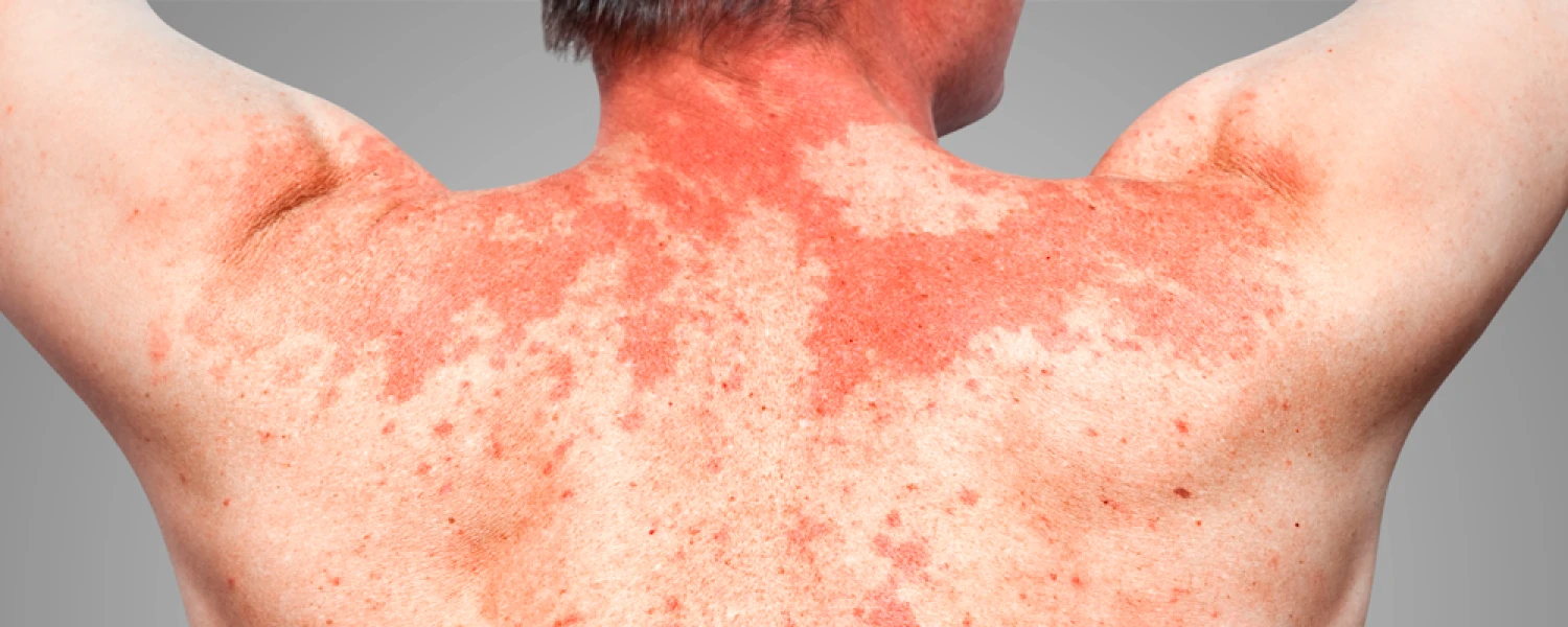 Alergia al sol: causas, síntomas y tratamientos