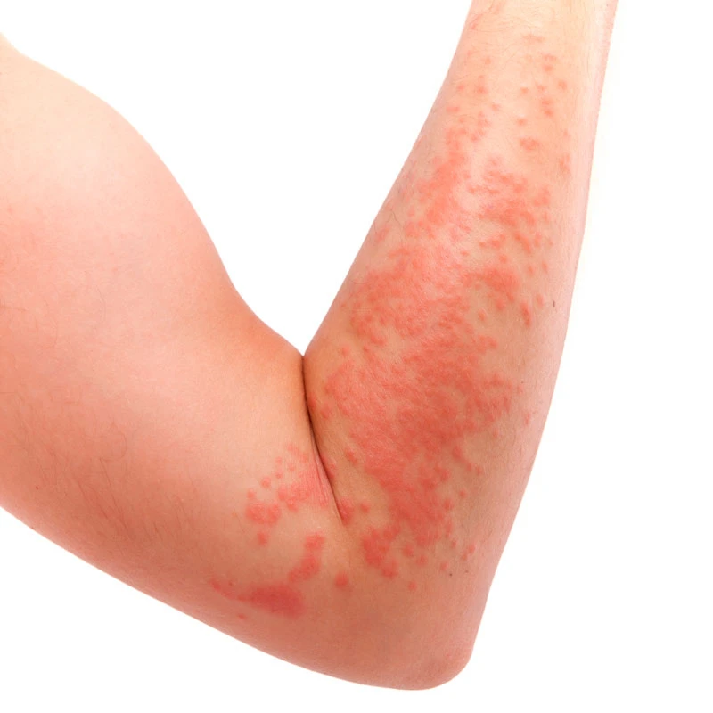 Síntomas de la alergia al sol